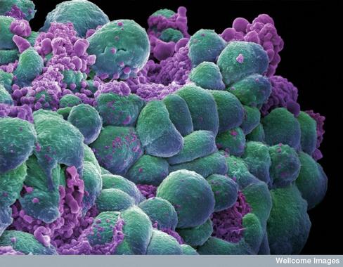 <p>Carcinoma de mama. Imagen: Wellcome Images</p>