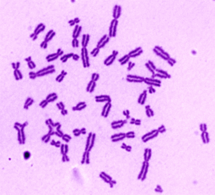 Resultado de imagen de anemia de fanconi