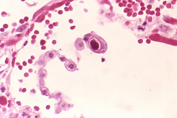 <p>La nueva diana es una proteína presente en todos los virus de la familia Herpesviridae. Foto: Centro para el Control y Prevención de Enfermedades.</p>