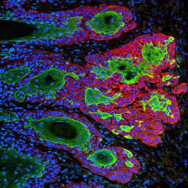 <p>Carcinoma de células escamosas, un tipo muy común de cáncer de piel. / <a href="http://www.nigms.nih.gov/education/life-magnified/Pages/11B_skin_cancer_cells.aspx" target="_blank">Markus Schober and Elaine Fuchs, The Rockefeller University</a><em>.</em></p>