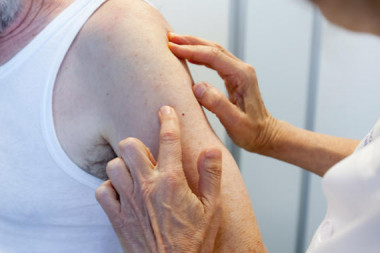 <p>El melanoma es el tipo más grave de cáncer de piel. / HUNSC</p>