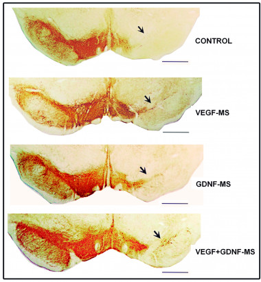 <p>Las secciones histológicas muestran diferentes grados de afectación o recuperación de la sustancia negra. Esta formación se tiñe para poner de manifiesto la enzima tirosina hidroxilasa (precursora de la dopamina), en grupos tratados con microesferas vacías (grupo control), con microesferas cargadas con VEGF (VEGF-MS), con microesferas cargadas con GDNF (GDNF-MS) y con microesferas cargadas con VEGF y GDNF de forma combinada (VEGF+GDNF-MS). La flecha indica la zona de la sustancia negra donde hay mayor regeneración (mayor positividad, marcaje más marrón) Corresponde con el grupo tratado con microesferas cargadas con VEGF y GDNF. Barra de escala= 1 mm. (Catalina Requejo)</p>