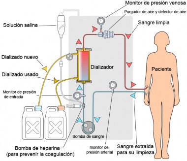 <p>Diagrama esquemático de un circuito de hemodiálisis. Este método consigue la circulación de agua y solutos entre la sangre y el baño para disminuir los niveles en sangre de sustancias tóxicas cuando están en exceso. / Wikipedia</p>