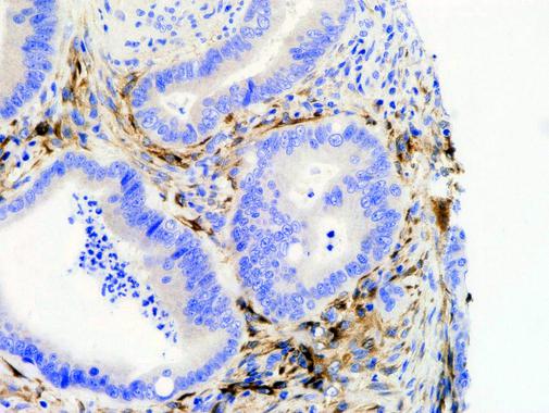<p>Células de carcinoma colorrectal / Enzymology Applied to Drug Discovery</p>