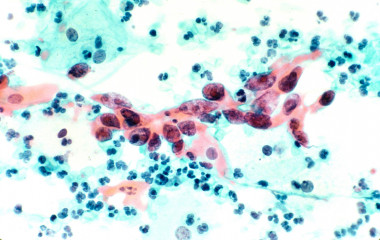 <p>Carcinoma de células escamosas del cuello uterino. / Crédito: visualsonline.cancer.gov/details.cfm?imageid=2578</p>