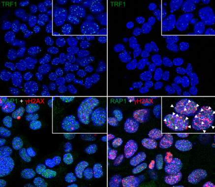 <p>Las células de cáncer de pulmón tratadas con el inhibidor de TRF1 del CNIO ETP-47037 (derecha) muestran menos TRF1 unido a sus telómeros (verde, arriba) y un mayor daño del ADN telomérico (rosa, abajo) —y por tanto una mayor desprotección de los telómeros— que las células cancerosas sin tratar (izquierda). <strong><strong>/ </strong></strong>CNIO</p>
