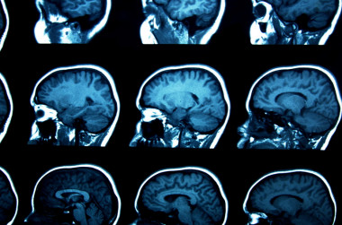 <p>Imagen de un TAC cerebral. / Fotolia</p>