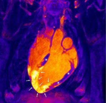 <p>Imagen de resonancia magnética tridimensional en un sujeto tras un infarto agudo de miocardio. En el centro de la imagen aparece el corazón. El músculo cardiaco sano (no infartado) está marcado con asteriscos, mientras que las flechas señalan la región de corázon que ha sufrido el infarto. Con resonancia magnética se puede visualizar la extensión de area de inflamación y edema tras el infarto (zona amarilla señalada con las flechas). Haciendo resonancia magnéticas seriadas, se puede ver como esta reacción inflamatoria aparece inmediatamente tras el infarto pero luego se resuelve muy rápido para luego volver a aparecer días tras el infarto.</p>