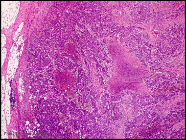 <p>Patológica de cáncer colorrectal. Imagen: Dicyt.</p>