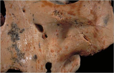 <p>Cráneo de <em>Homo antecessor</em> en el que se observan las marcas de corte producidas al ser consumido por otros homínidos. Imagen: IPHES.</p>