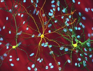 <p>Imagen de microscopio de las neuronas espinosas medias (amarillo) con inclusiones nucleares (naranja), producidas como parte del proceso de la enfermedad de Huntington. / Steven Finkbeiner / <a href="https://en.wikipedia.org/wiki/Huntington%27s_disease#/media/File:Neuron_with_mHtt_inclusion.jpg" target="_blank">Wikipedia</a></p>