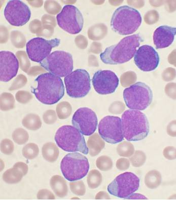 <p>Frote sanguíneo de precursores linfocíticos en una leucemia linfoide aguda. / <a href="https://en.wikipedia.org/wiki/Leukemia#/media/File:Acute_leukemia-ALL.jpg" target="_blank">Wikipedia</a></p>