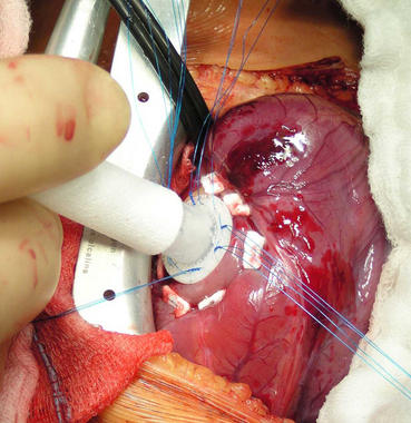 <p>Intervención quirúrgica. Foto: Hospital universitario La Paz.</p>