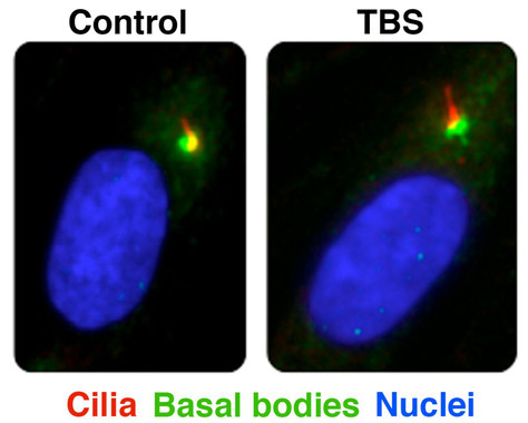 <p>Células derivadas de control y de personas afectadas por el síndrome de Townes-Brocks (TBS), en las que se puede observar cilios primarios en rojo, cuerpos basales en verde y los núcleos en azul. Autor: CIC bioGUNE (Rosa Barrio)</p>