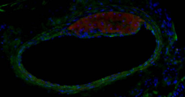 <p>Detección de inmunofluorescencia de una placa de aterosclerosis en arteria carótida (verde: células musculares lisas; rojo: macrófagos o células espumosas; azul: núcleos). / Mario Delgado</p>
