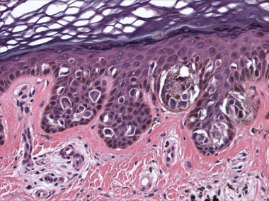 <p>El melanoma es, junto al cáncer de colon, una enfermedad que se podría combatir empleando esta nueva célula / <a href="http://www.flickr.com/photos/edgepath/4419926989/sizes/o/" target="_blank">Edgepath</a></p>