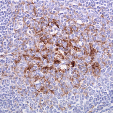 
<!-- START: including template: extension/sinc/design/ezwebin/templates/content/datatype/view/ezxmltags/paragraph.tpl (design:content/datatype/view/ezxmltags/paragraph.tpl) -->
<p>Biopsia de una amígdala en una variante de Creutzfeldt-Jakob. Inmunotinción de proteína de priones. 
<!-- START: including template: extension/sinc/design/standard/templates/content/datatype/view/ezxmltags/link.tpl (design:content/datatype/view/ezxmltags/link.tpl) -->
<a href="http://plataformasinc.es/index.php/esl/En-exclusiva/Imagenes-embargadas/Hallan-una-pieza-clave-para-el-tratamiento-de-la-enfermedad-de-las-vacas-locas" target="_self">Foto: Wikipedia</a>
<!-- STOP: including template: extension/sinc/design/standard/templates/content/datatype/view/ezxmltags/link.tpl (design:content/datatype/view/ezxmltags/link.tpl) -->
.</p>
<!-- STOP: including template: extension/sinc/design/ezwebin/templates/content/datatype/view/ezxmltags/paragraph.tpl (design:content/datatype/view/ezxmltags/paragraph.tpl) -->
