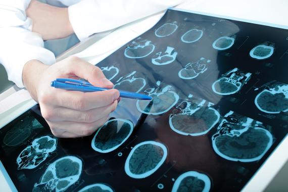 <p>TAC craneal realizado a paciente con ictus cerebral. / Fotolia</p>