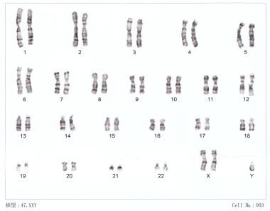 <p class=" text-left">El síndrome de Klinefelter se debe a la presencia de un cromosoma X extra. Un 75% de estos individuos tienen un cariotipo 47,XXY. / Wikimedia Commons</p>