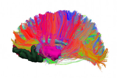 <p>Reconstrucción de conexiones cerebrales a partir de imágenes de resonancia magnética, donde se visualizan estructuras del sistema de refuerzo y las fibras de la sustancia blanca del cerebro. / UB</p>
