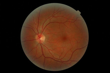 <p>La enfermedad, hereditaria y poco frecuente, se caracteriza por la pérdida progresiva de la capacidad visual como consecuencia de la muerte de las células fotorreceptoras. / ONCE</p>