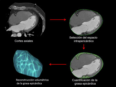 <p>Proceso de cuantificación de grasa epicárdica mediante Tomografía Computarizada (TC) cardíaca. / Vicenta Llorente: / IBB Sant Pau/ CIBERCV</p>