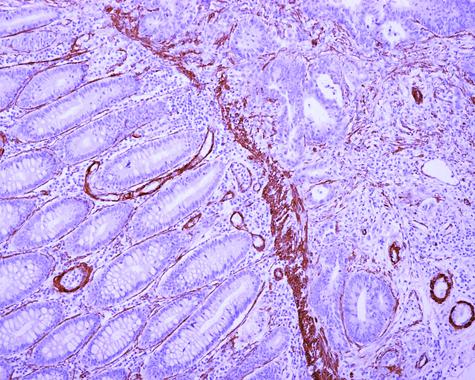 <p>A la izquierda, fibroblastos de la mucosa sana, adyacente al tumor; a la derecha, fibroblastos asociados a carcinoma. IDIBELL</p>