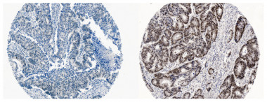 <p>Muestras humanas de cáncer colorrectal con niveles bajos de la proteína MCRS1 (izquierda) y niveles elevados de la misma (derecha). / Nabil Djouder (CNIO)</p>