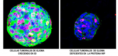 <p>Células tumorales de glioma. / UAM</p>