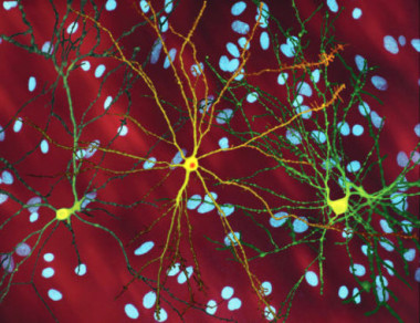 <p>Imagen de microscopio de las neuronas espinosas medias (amarillo) con inclusiones nucleares (naranja), producidas como parte del proceso de la enfermedad de Huntington. / Steven Finkbeiner / Wikipedia</p>