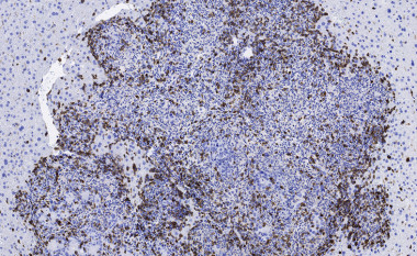 <p>Tumor metastásico de colon infiltrado por el sistema inmunitario (en marrón) tras la combinación del inhibidor de TGF-beta e inmunoterapia. / Daniele Tauriello, IRB Barcelona</p>