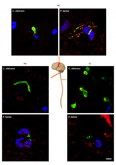 <p class=" text-left">Presencia de estructuras fúngicas en distintas partes del sistema nervioso central de un paciente de ELA detectadas mediante inmunohistoquímica. / UAM</p>