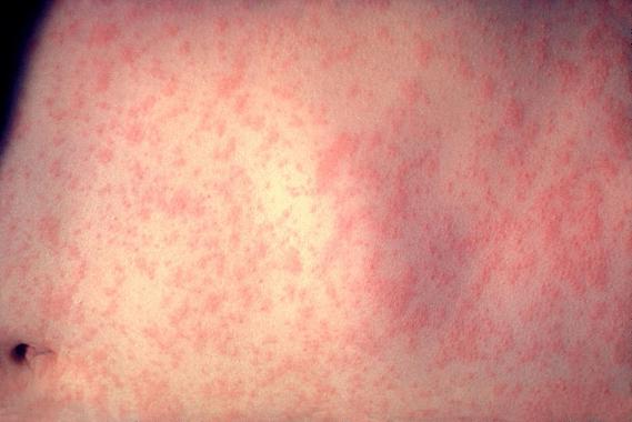 <p>El sarampión es una enfermedad viral altamente contagiosa, que afecta sobre todo a los niños. / <a href="http://es.wikipedia.org/wiki/Sarampi%C3%B3n#mediaviewer/File:Morbillivirus_measles_infection.jpg" target="_blank">Wikipedia</a></p>