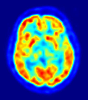 <p>Escaner cerebral de un paciente con esquizofrenia. Foto: Wikipedia.</p>