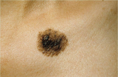 <p>Nevus clínicamente atípico (color heterogéneo y de grandes dimensiones). / HUB.</p>