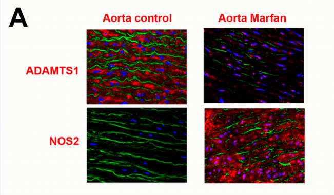 <p>La inhibición de la proteína NOS2 tiene potencial terapéutico en síndrome de Marfan. (A) Se muestran los cambios que se producen en la expresión de las proteínas ADAMTS1 y NOS2 (ambas en color rojo) y las alteraciones de las fibras elásticas (en verde) en la pared sana de la aorta de donantes (Aorta control) y en la de pacientes con síndrome de Marfan (Aorta Marfan). / CNIC</p>