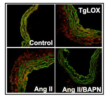 <p>
Las arterias de ratones que sobreexpresan lisil oxidasa (TgLOX) muestran mayores niveles de estrés oxidativo (tinción roja) que los animales control. El aumento del estrés oxidativo observado en un modelo de hipertensión arterial por infusión de Angiotensina II, se reduce drásticamente en presencia de un inhibidor farmacológico de la lisil oxidasa (BAPN). / UAM-ICCC-CSIC<br />
<strong> </strong><br /><strong> </strong></p>