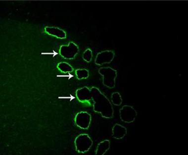 <p>Captura láser de las células POMC. La ampliación del ARN de estas células permite reconocer los receptores de nicotina. Foto: Science/AAAS</p>