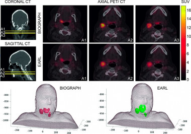 <p>Dos Protocolos de reconstrucción de imágenes PET/TAC para un mismo caso de estudio, y los volúmenes tumorales obtenidos en 3D. / Elisa Jiménez-Ortega et al.</p>