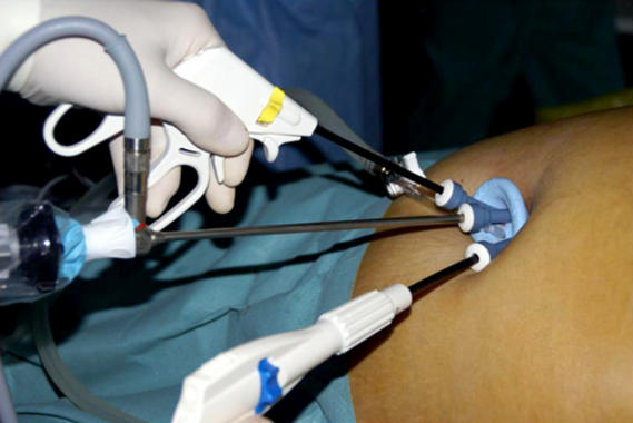 <p>Los cirujanos pueden reducir el número de incisiones cutáneas de cuatro a una, y conseguir una disminución del dolor postoperatorio al reducir el número de accesos. Foto: Hospital Clinic.</p>