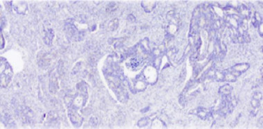 <p>Visión en microscopio de un cáncer de colon incluido en el estudio. / IDIBELL</p>