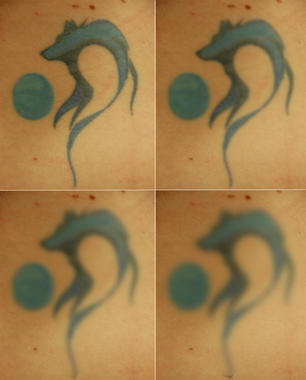 <p>De izquierda a derecha y de arriba abajo: aspecto de un tatuaje en la actualidad y dentro de dos, diez y veinte años. Imagen: SINC</p>