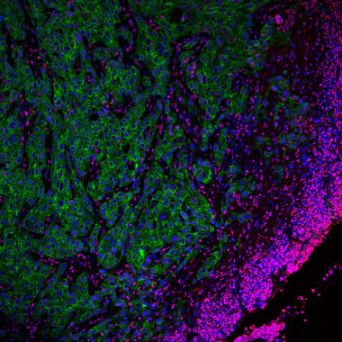 <p>Frente invasivo de células tumorales altamente agresivas. / Imagen de microscopía confocal. Alexandra Avgustinova, IRB Barcelona.</p>