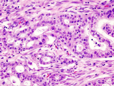 <p>Cálulas cancerígenes de cáncer pancreático./ <a href="http://en.wikipedia.org/wiki/Pancreatic_cancer#mediaviewer/File:Pancreas_adenocarcinoma_(4)_Case_01.jpg" target="_blank">Wikipedia</a></p>