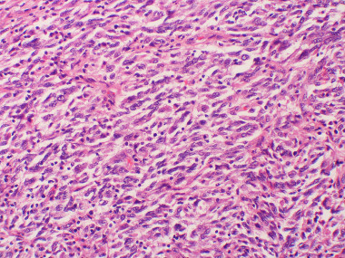 <p>Muestra celular de melanoma con metástasis. / <a href="https://www.flickr.com/photos/pulmonary_pathology/5600773581/in/photolist-a86PYi-7jz8aF-dqasTi-dtQoYA-fQf1jP-a86Si4-2utsrq-9wVqRK-9wYqcQ-9wVr12-bCQqod-dUd4dG-ttunps-6Xkimq-6XkiAS-7fo2JQ-ccsKK5-9zHg1K-9zMntf-9zMnpJ-9zHjgx-9zJo8M-kh5dAQ" target="_blank">Yale Rosen</a>.</p>