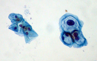 <p>Healthy cervical cells on the left and infected with HPV on the right. / Euthman</p>