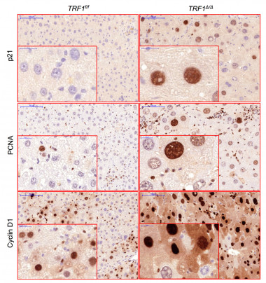 <p>Las células hepáticas sin TRF1 (derecha) presentan, bajo estrés crónico, núcleos más grandes y otros marcadores propios de pacientes con cirrosis o hepatitis en comparación con las células normales sometidas al mismo estímulo (izquierda). / CNIO</p>