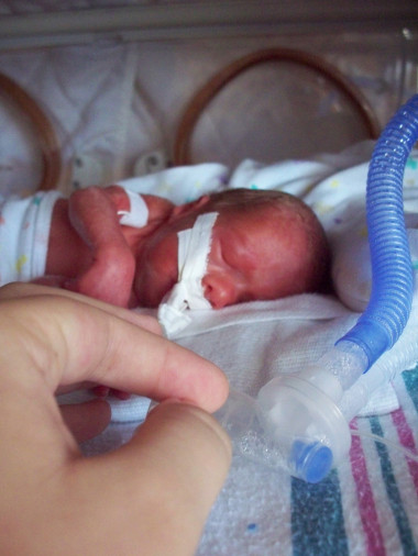 <p>Bebé prematuro con ventilador. / Wikipedia Commons (Imagen etiquetada para su reutilización)</p>