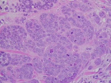 <p class=" text-center">Micrografía que muestra un cáncer de mama. / <a href="http://en.wikipedia.org/wiki/File:Invasive_Ductal_Carcinoma_40x.jpg" target="_blank">Wikipedia</a></p>