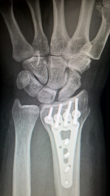 <p>La osteogénesis por distracción ósea es un procedimiento de reconstrucción en el que se utiliza un elemento externo denominado distractor que separa gradualmente el hueso / Fundación Descubre</p>